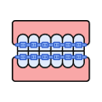 Dental Braces Fixing